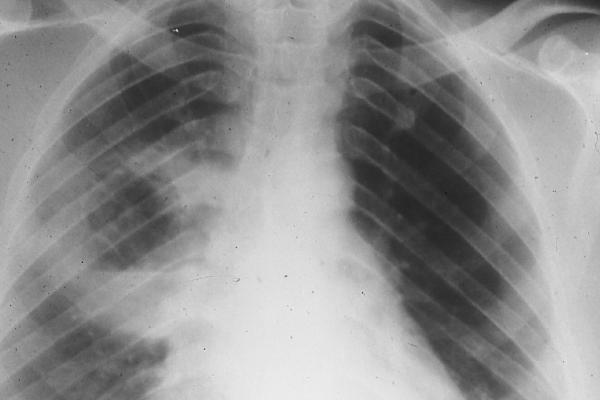 Lungs