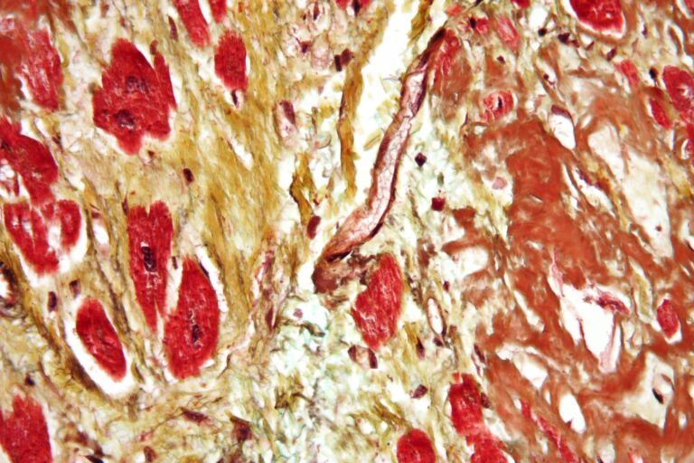 Cardiac amyloidosis very high mag movat1 768x512