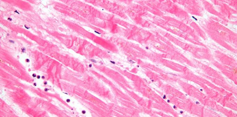 MI with contraction bands very high mag1 768x380